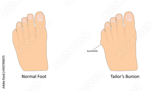 Tailor's bunion vector illustration