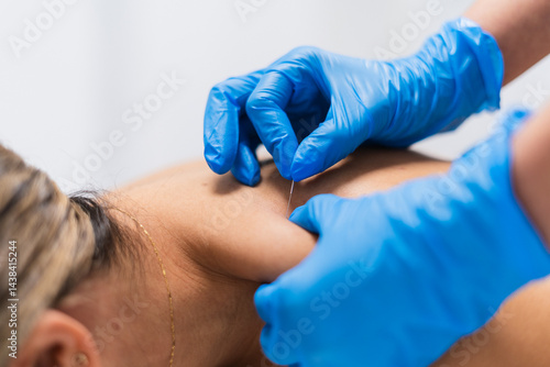 Doctor performing acupuncture therapy on female patient's shoulder for pain relief