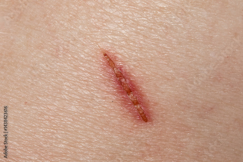 Healing wound showing scar tissue forming on skin