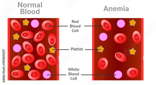 Anemia, low level red blood cells. Section showing normal and anemia blood contents. Vector illustration