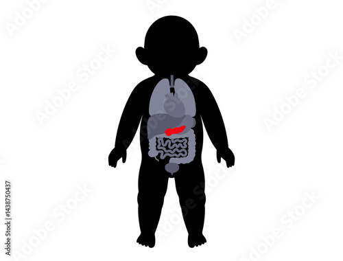 Pancreas diseases in a child
