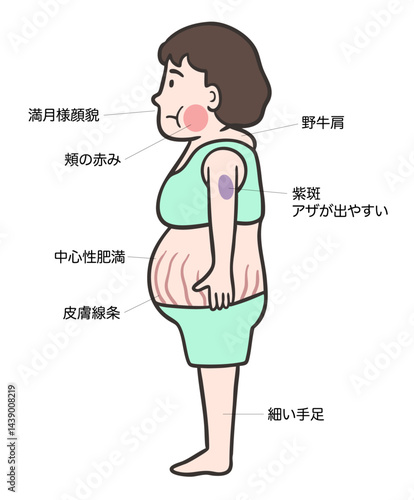 クッシング症候群の女性の側面、 特徴的な体型と症状