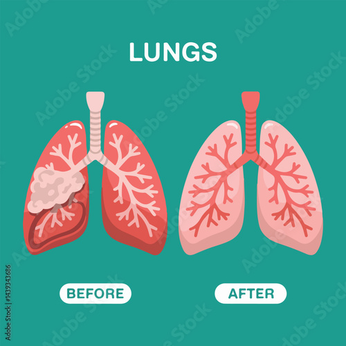 World Bronchiectasis Day flat vector graphics pack with informative lung designs, bronchial tree patterns, support ribbon, patient care scenes, and solid color medical icons for awareness