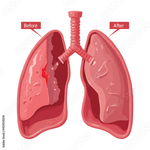 World Bronchiectasis Day flat vector graphics pack with informative lung designs, bronchial tree patterns, support ribbon, patient care scenes, and solid color medical icons for awareness