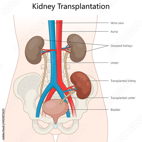 placement of a transplanted kidney and ureter in the human body alongside the diseased kidneys and major blood vessels diagram hand drawn schematic vector. Medical science educational illustration