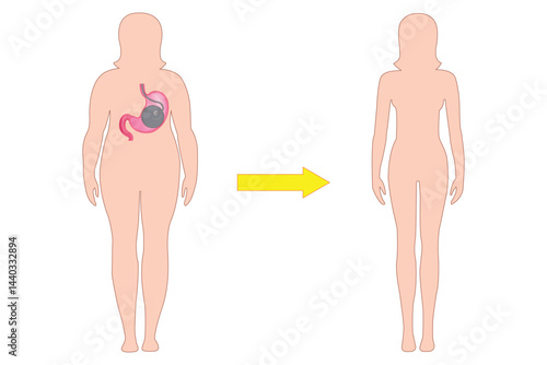 Obesity treatment graphic showing gastric balloon for weight reduction and slim body result.