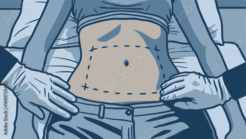 A detailed medical illustration depicting preoperative surgical markings on the abdomen