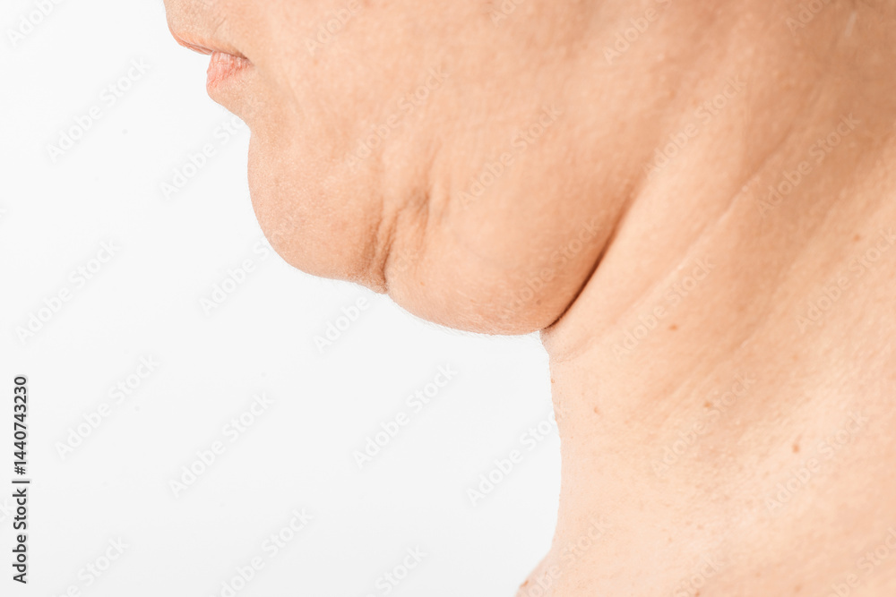Fototapeta premium Neck and double chin of a middle-aged woman. Weakened muscles, sagging skin due to loss of collagen in the skin and wrinkles.