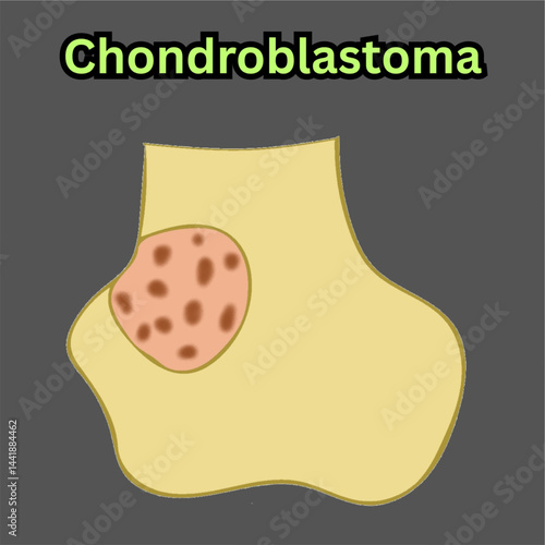 chondroblastoma non cancerous bone tumor in long bone illustration useful for educational and healthcare industries orthopedics