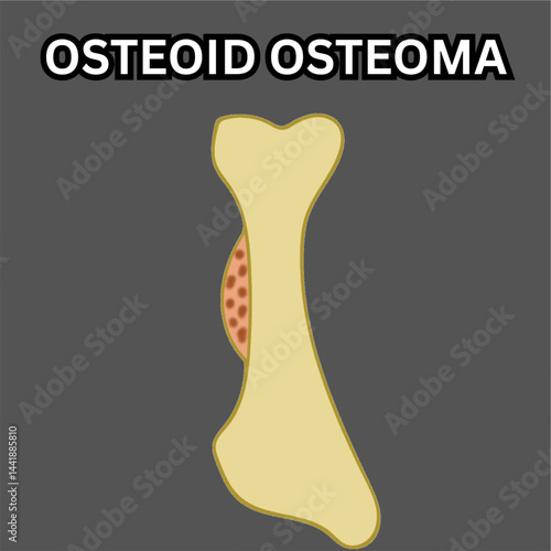 osteoid osteoma non cancerous bone tumor in long bone illustration useful for educational and healthcare industries orthopedics