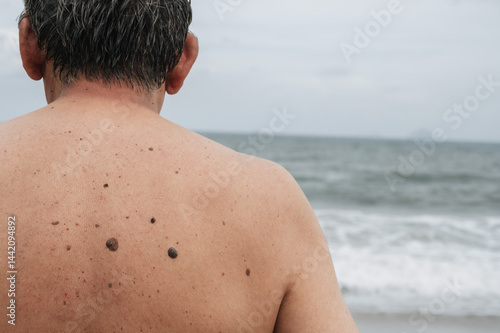 Wallpaper Mural The back of an elderly man with freckles, aging spots, black, brown warts and wrinkles against the background of the sea Torontodigital.ca