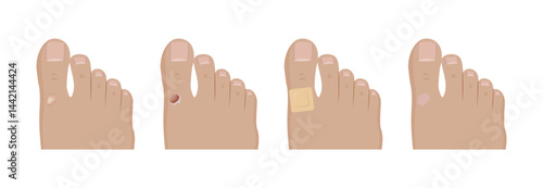 Friction blister developing and healing on toe, first aid treatment