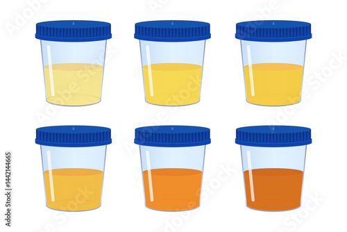 Medical urine test showing different colors, indicating various health conditions