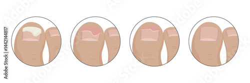 Toenail recovering from onycholysis, fungal infection or trauma