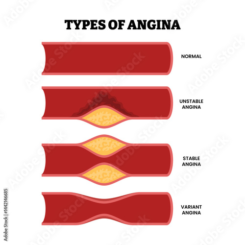 Different types of angina as chest pain and heart problem or myocardial infarction, educational medical poster design healthcare scheme, labeled normal, stable, unstable, variant. Artery Disease.