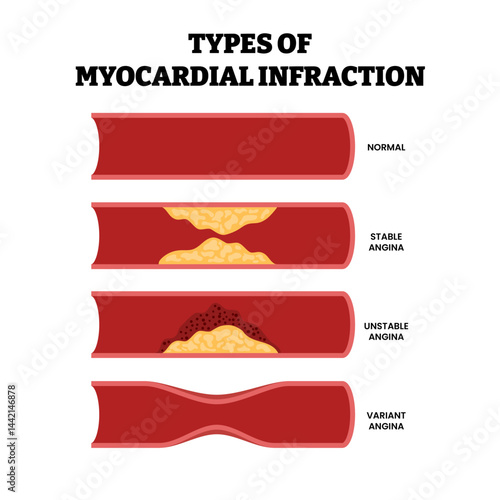 Different types of angina as chest pain and heart problem or myocardial infarction, educational medical poster design healthcare scheme, labeled normal, stable, unstable, variant. Artery Disease.