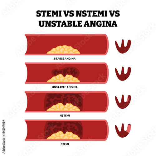 Different types of STEMI vs NSTEMI as stable angina or unstable angina types, educational medical poster design healthcare scheme, labeled myocardial infarction as heart disease or chest pain.