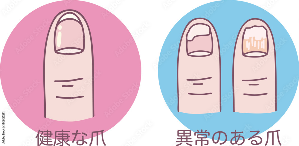 Φωτογραφία 健康な爪と異常のある爪の分かりやすいイラスト