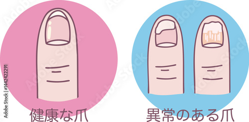 健康な爪と異常のある爪の分かりやすいイラスト