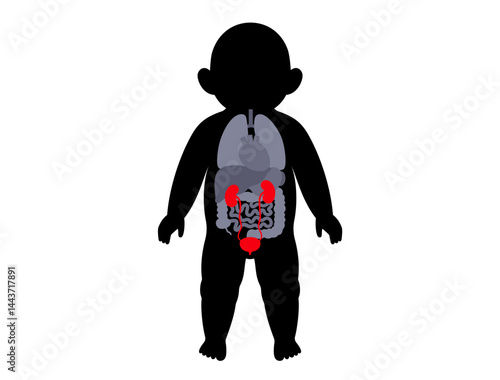 Kidney diseases in a child