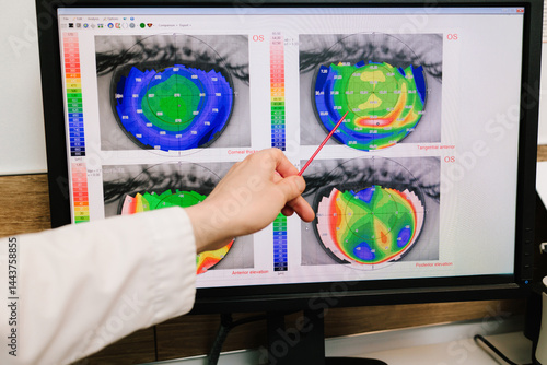 Diagnosis of the cornea and eyes in ophthalmology clinic. Ophthalmologist is showing corneal topography scan to girl patient near slit lamp.