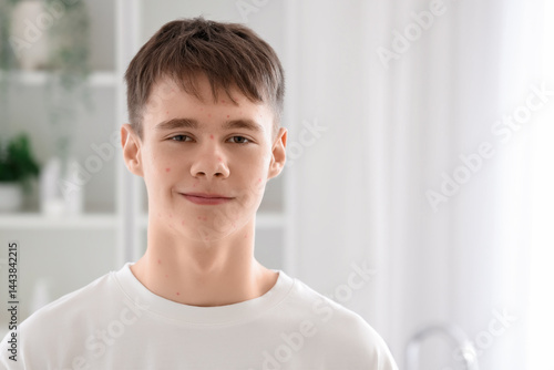 Teenage boy with acne probl...