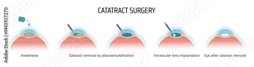 Vectorial medical poster cataract surgery. Stages of lens removal and replacement with a new lens.
