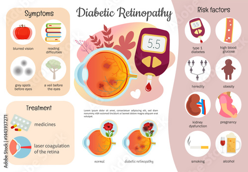 Vector medical poster infographic diabetic retinopathy. Symptoms, risk factors of eye disease.
