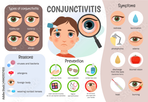 Vector infographics conjunctivitis. Medical poster types of disease, symptoms, prevention.
