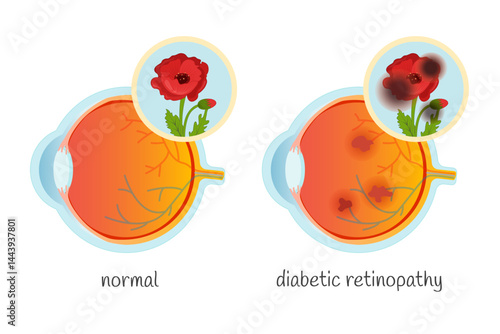 Vector medical poster normal eye and eye with diabetic retinopathy.
