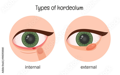 Vector medical illustration of hordelium types.
