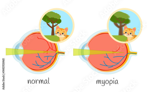 Vector medical illustration of vision impairment. Eye diseases myopia, normal.
