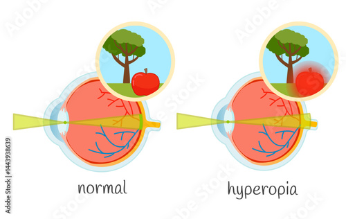 Vector medical illustration of vision impairment. Eye diseases hyperopia, normal.
