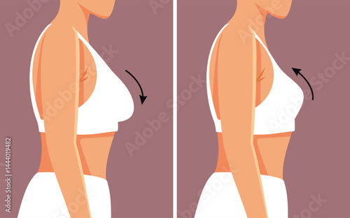 Breast Lift Surgery Results Before and After Vector Illustration. Patient who improves the shape of her breasts affected by aging 

