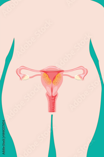 Medical illustration of adenomyosis in female uterus with highlighted thickened endometrial tissue