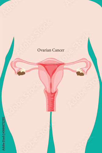 Ovarian cancer diagram showing tumor growth in the ovaries. Eps 10