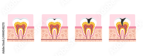 Tooth decay progression stages cross section for dental education, showing enamel damage, dentin exposure, and pulp infection.