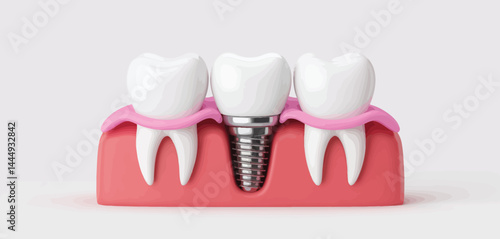 Dental Implant Crown with Adjacent Teeth 3D Model
