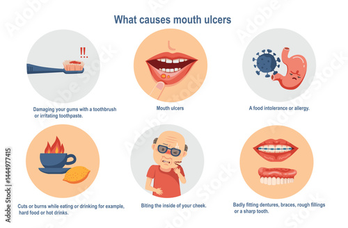 what causes mouth ulcers