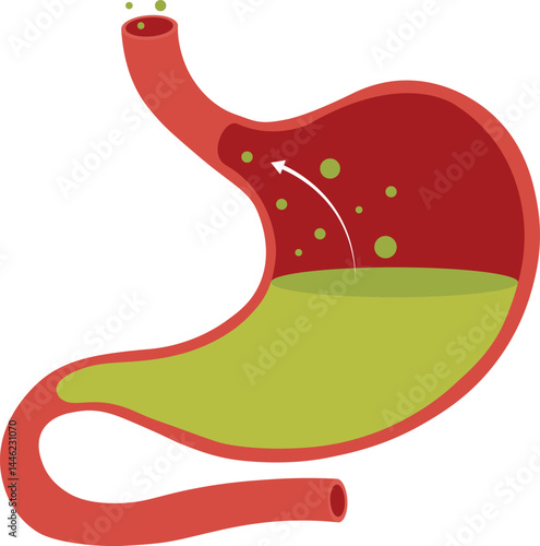 Human stomach full of stomach acid. Acid reflux or gastroesophageal reflux, Heartburn. Stomach disease, stomach problem disease concept. Vector drawing.
