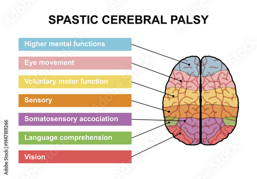 Spastic Cerebral Palsy Brain Illustration