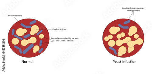 Yeast infection vector illustration