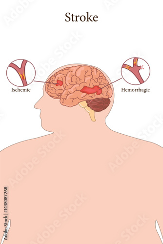 Medical illustration showing ischemic and hemorrhagic stroke in obese human brain anatomy.