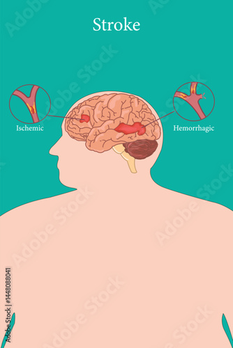 Stroke types diagram highlighting ischemic and hemorrhagic strokes inside overweight male brain
