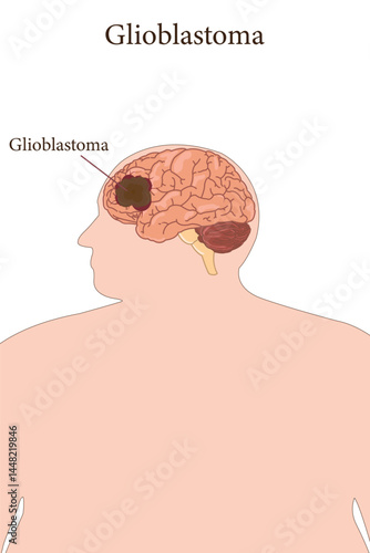 Medical illustration of glioblastoma brain tumor in overweight male on green background. eps 10