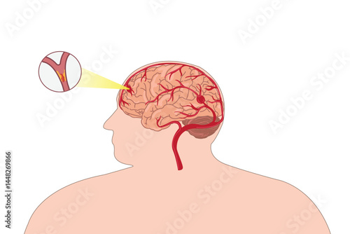 Medical illustration of hemorrhagic stroke showing bleeding in the brain.