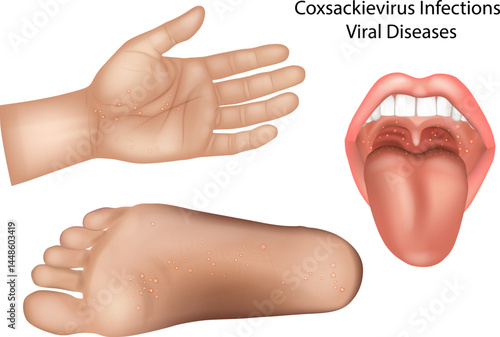 Detailed medical illustration showing typical symptoms of Coxsackievirus infection, including vesicular rashes on the palms, soles, and inside the mouth. Coxsackievirus Vesicular Rash on Palm, Sole, a