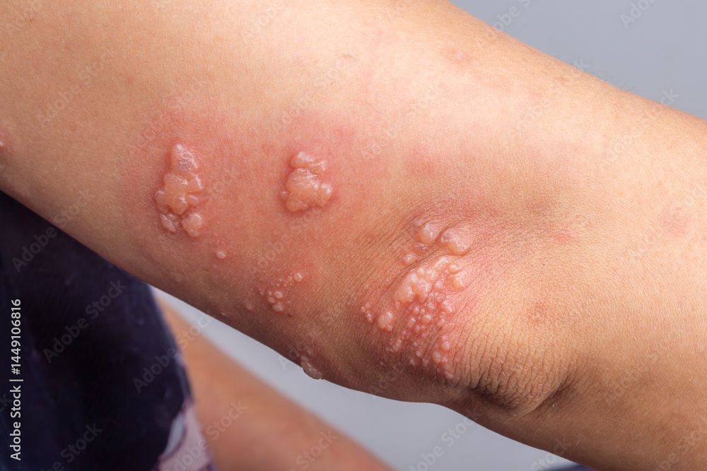 Fototapeta premium Shingles, Zoster or Herpes Zoster symptoms on arm.