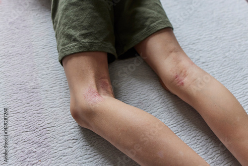 Child's legs with eczema