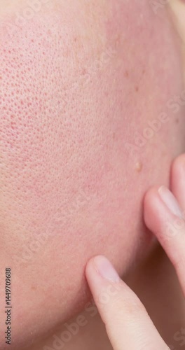 Vertical. Close-up of human cheek with prominent pores, redness, skin inflammation, sensitive or problem skin. Hand touching skin, concept of care, diagnosis or dermatology problems.